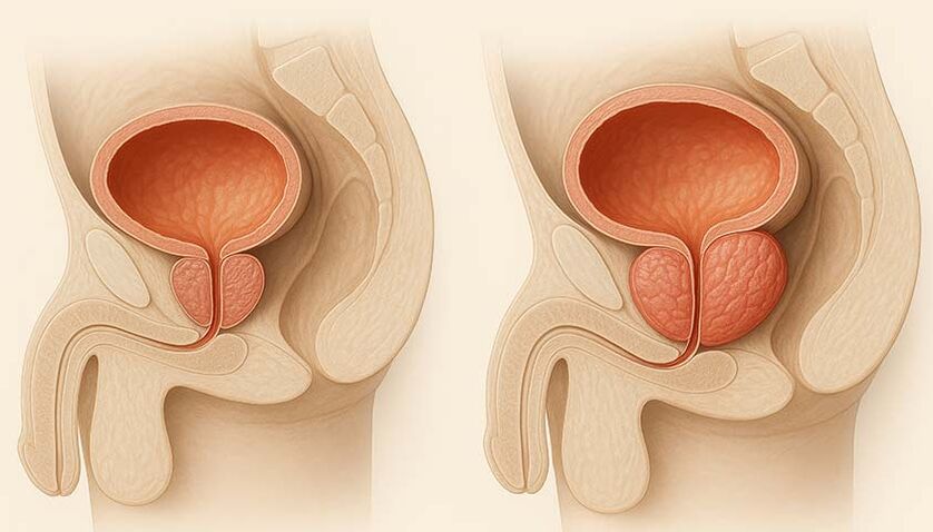 Ademunal en el tratamiento de prostatitis y adenoma.