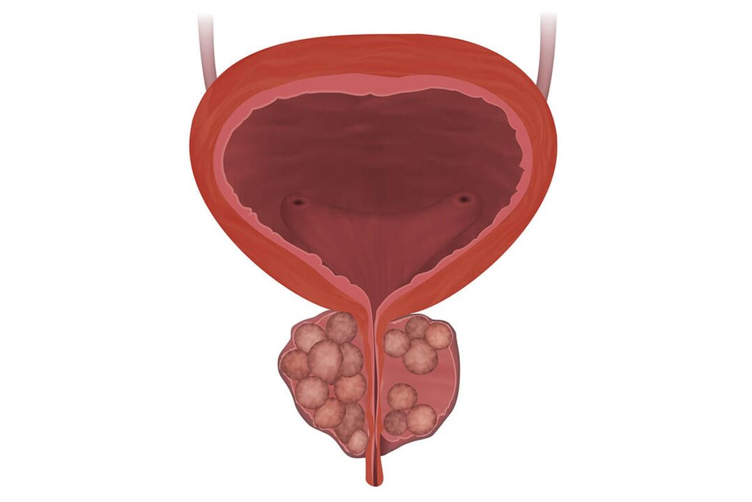 Síntomas de prostatitis